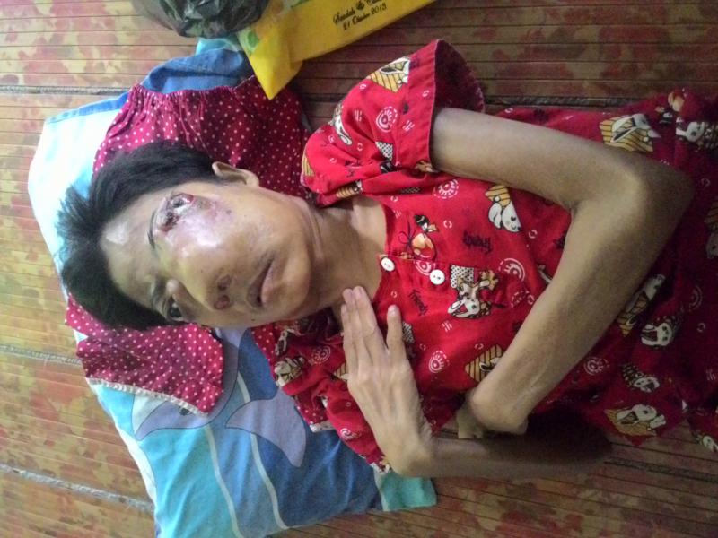 Tumor Ganas Gerogoti Wajah, Yusmaneti Nyaris Tak Bisa Melihat