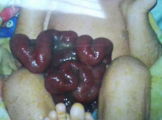 Bayi ini Lahir dengan usus Diluar Perut