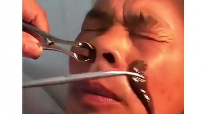 Ngeri, 10 Hari Lintah Ini Hidup di dalam Hidung. Berani Baca?..