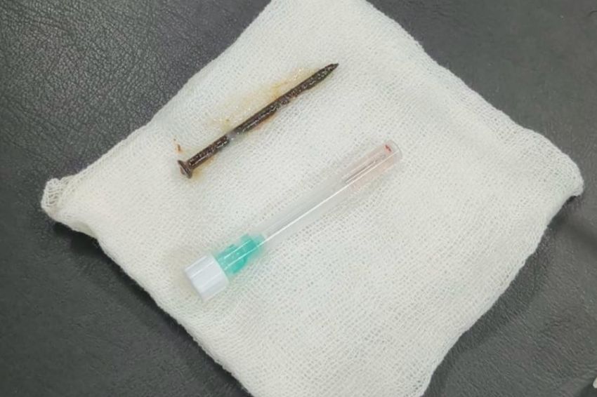 Tersedak Paku 5 Cm, Pasien Berhasil Diselamatkan Tim Dokter RSUD Arifin Achmad